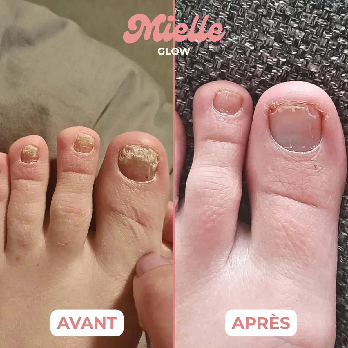 🪄 Stylo réparateur ongles de pieds - Traitement antifongique